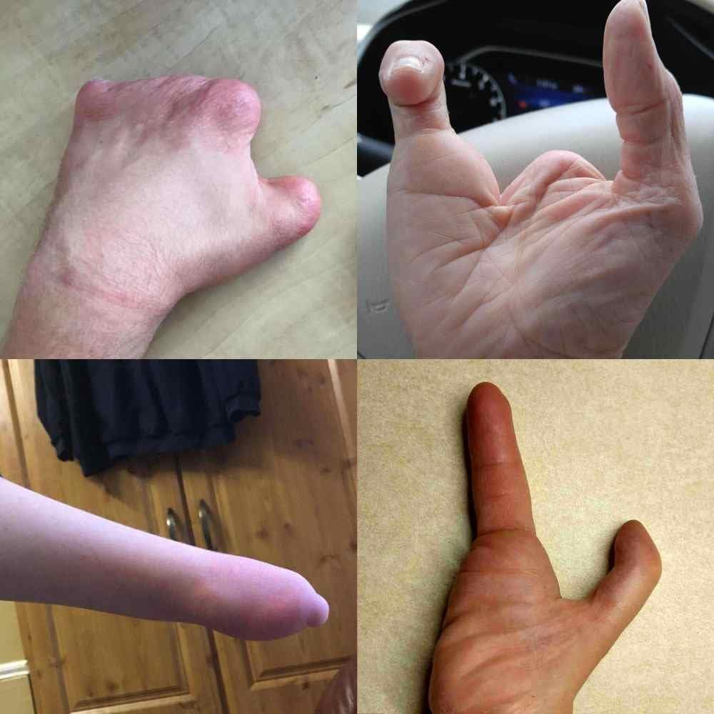 active hands Limb Difference Aid – for Gripping in Gym/Home with Missing Fingers/Hand Parts